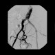Stenosis of common iliac artery, stent: AG - Angiography